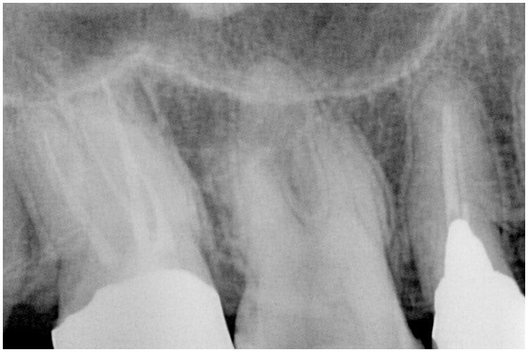 症例7　抜髄　非外科　大臼歯 治療後